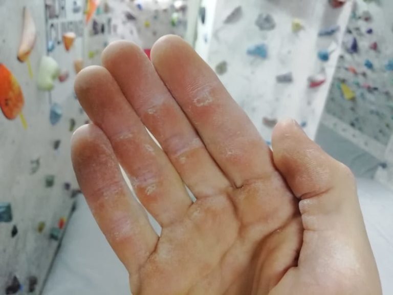 Rock Climbing Hand Care How to Take Care of Your Callus