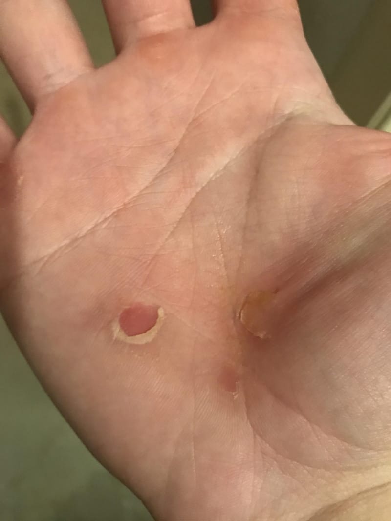 callus
