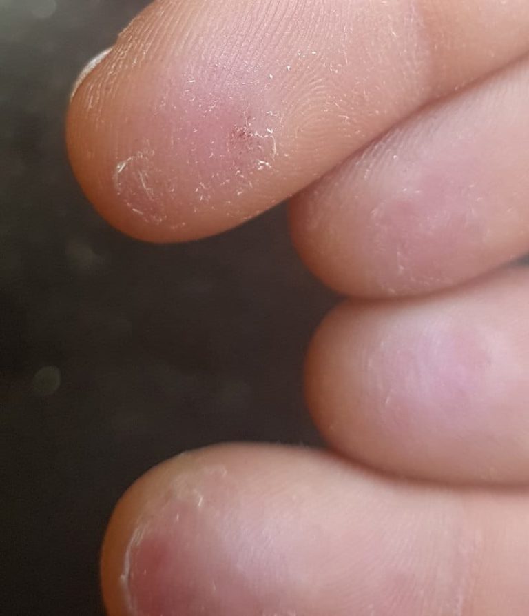 How To Tape Fingers For Climbing Both Fingertips & Hands